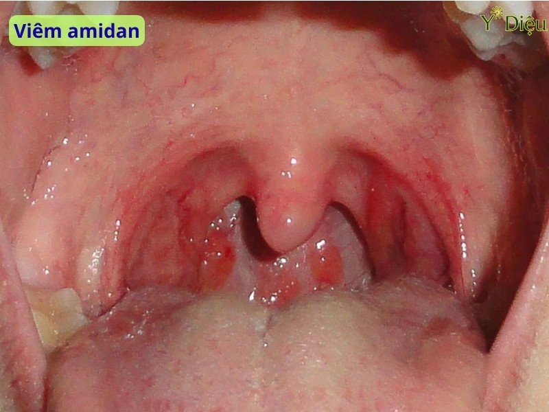 Việc điều trị viêm amidan nội khoa cần dựa trên nguyên nhân cụ thể